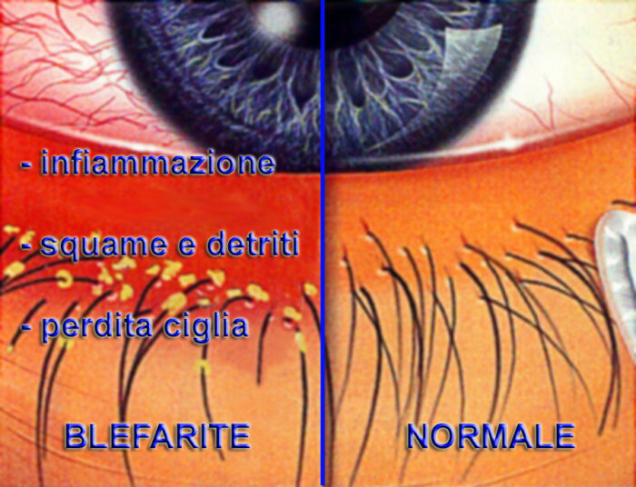 blefarite_schema_ok-700×536