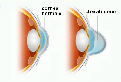 cheratocono-2