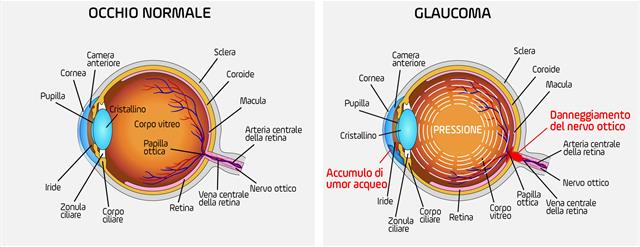 glaucoma2